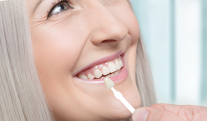 Image of a dental professional placing a veneer in a patient's mouth, at Excel Dental in Battleground, WA.