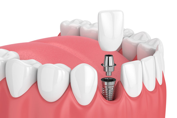 Rendering of jaw with dental implant at Excel Dental. Rendering of jaw with dental implant at Excel Dental.